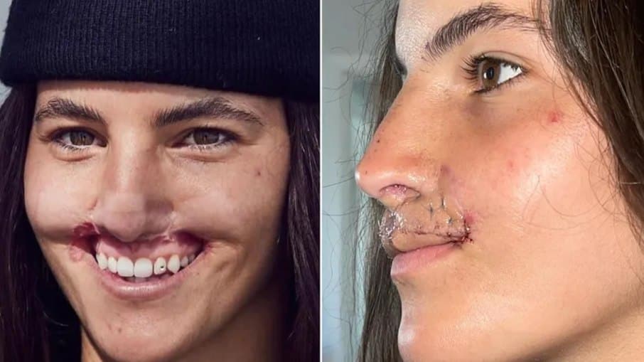 contioutra.com - Ataque de pitbull mudou o rosto de modelo &mdash; anos depois, ela revela resultado da reconstru&ccedil;&atilde;o