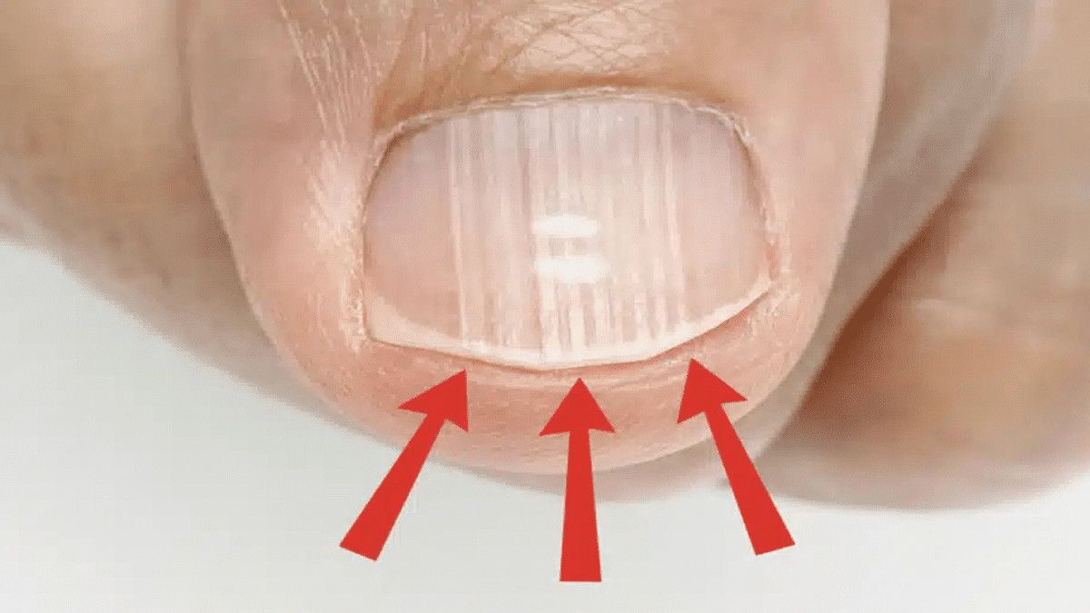 contioutra.com - Essas linhas nas unhas depois dos 40 podem dizer mais sobre sua sa&uacute;de do que voc&ecirc; imagina