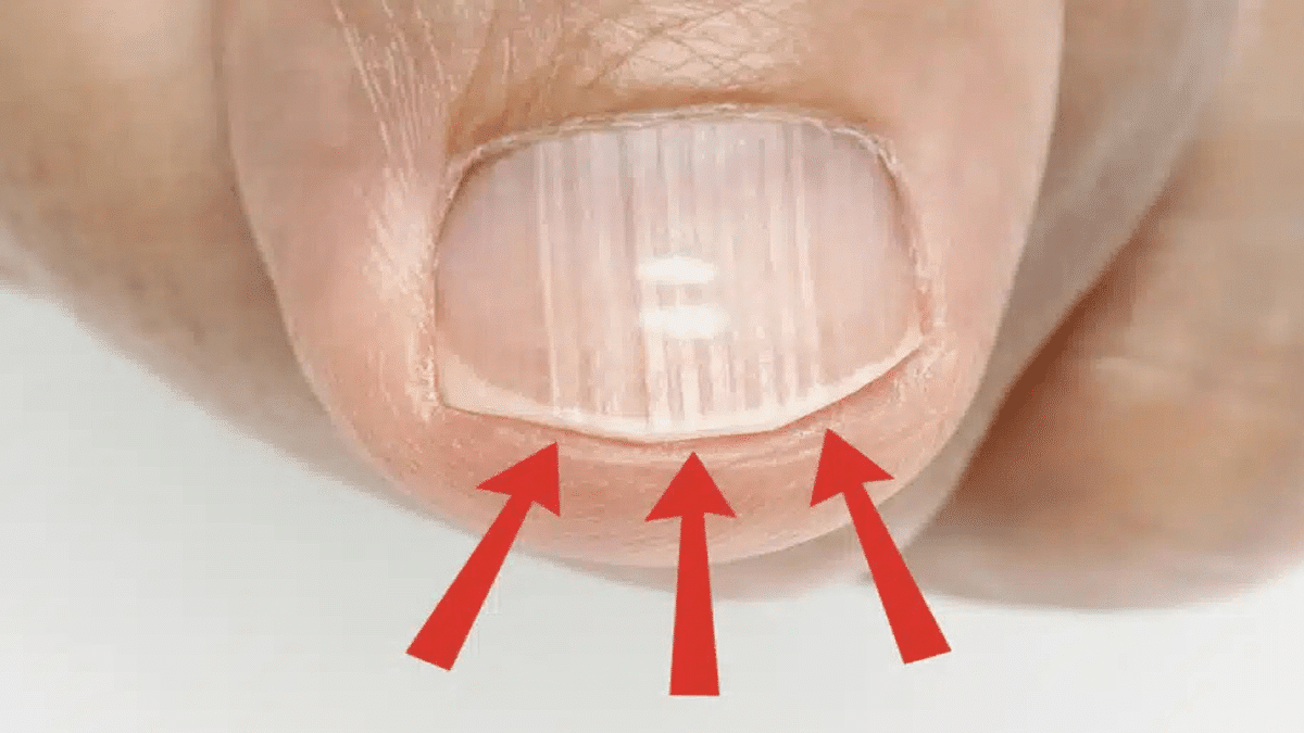contioutra.com - Essas linhas nas unhas depois dos 40 podem dizer mais sobre sua sa&uacute;de do que voc&ecirc; imagina