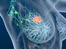 4 sinais precoces do câncer de mama que você não deve ignorar