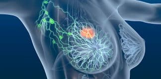 Muitas mulheres só percebem depois: 4 sinais precoces do câncer de mama que passam batido