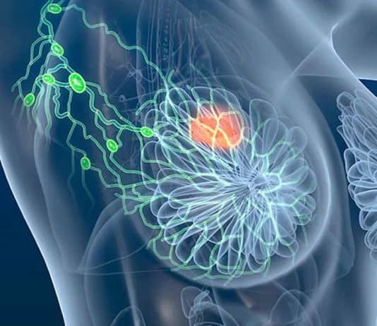 4 sinais precoces do câncer de mama que você não deve ignorar