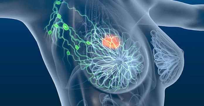 Muitas mulheres só percebem depois: 4 sinais precoces do câncer de mama que passam batido