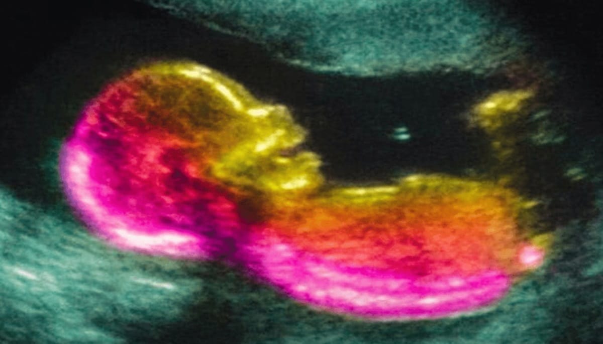 contioutra.com - Novo estudo liga autismo a fator inesperado durante a gesta&ccedil;&atilde;o e levanta alerta