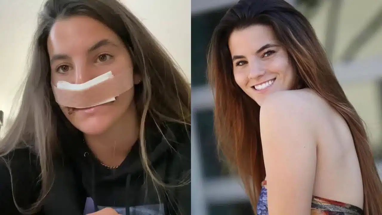 contioutra.com - Ataque de pitbull mudou o rosto de modelo &mdash; anos depois, ela revela resultado da reconstru&ccedil;&atilde;o
