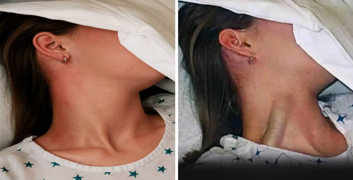 contioutra.com - Sinal cl&iacute;nico revelador sobre a sa&uacute;de: As consequ&ecirc;ncias do ingurgitamento jugular