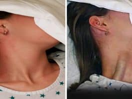 ingurgitamento jugular