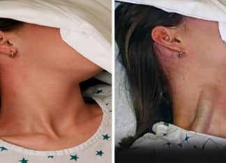 Sinal clínico revelador sobre a saúde: As consequências do ingurgitamento jugular