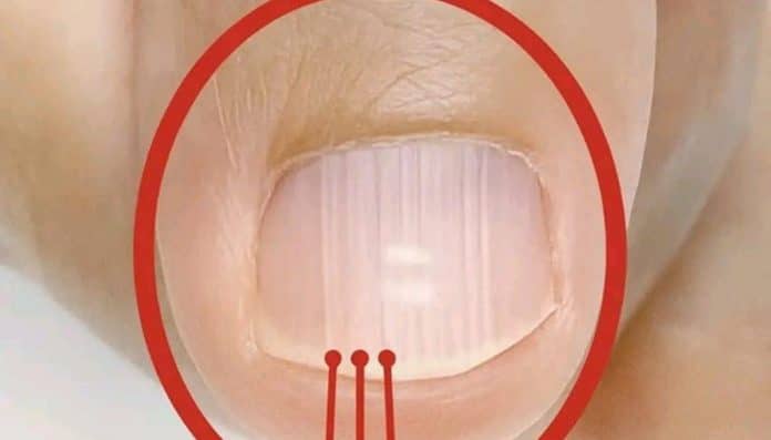 Essas linhas nas unhas depois dos 40 podem dizer mais sobre sua saúde do que você imagina