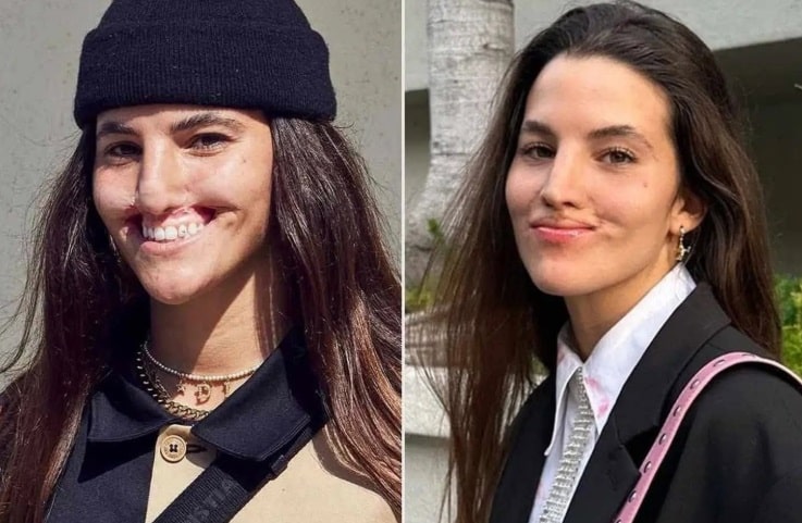 contioutra.com - Ataque de pitbull mudou o rosto de modelo &mdash; anos depois, ela revela resultado da reconstru&ccedil;&atilde;o