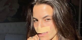 Ataque de pitbull mudou o rosto de modelo — anos depois, ela revela resultado da reconstrução