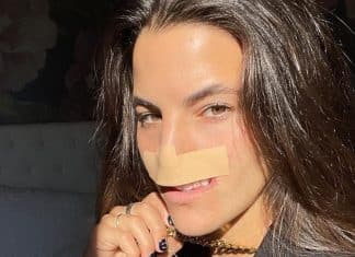 Ataque de pitbull mudou o rosto de modelo — anos depois, ela revela resultado da reconstrução