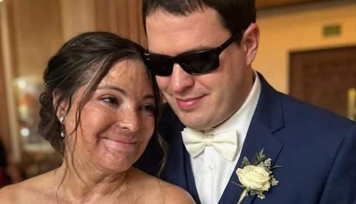 homem cego e mulher com cicatrizes c Ela se casou com um cego para esconder suas cicatrizes, mas a revelação na noite de núpcias mudou tudo