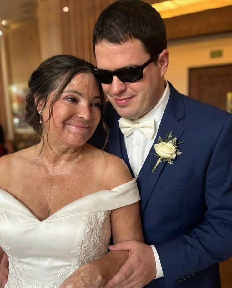 Ela se casou com um cego para esconder suas cicatrizes, mas a revelação na noite de núpcias mudou tudo contioutra.com - Ela se casou com um cego para esconder suas cicatrizes, mas a revelação na noite de núpcias mudou tudo