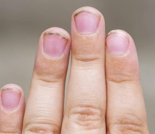 unhas suja