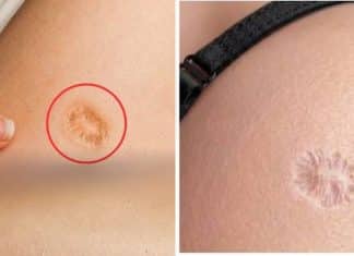 Essa marca redonda no braço não é de nascença: entenda o que ela pode significar