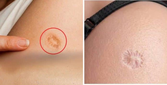 Essa marca redonda no braço não é de nascença: entenda o que ela pode significar