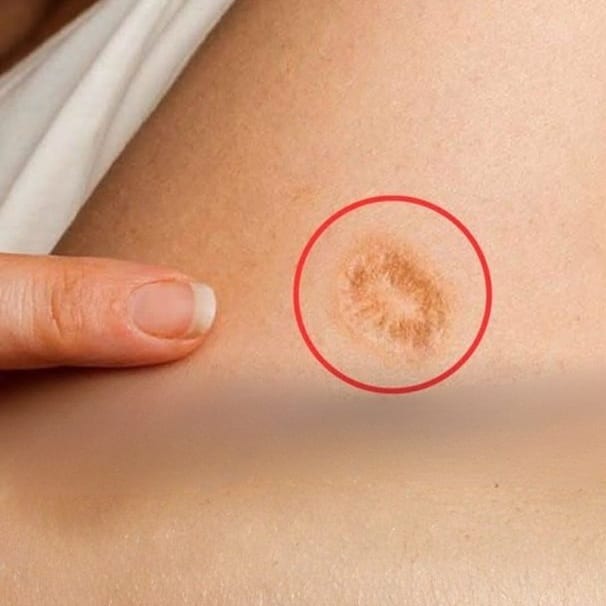 contioutra.com - Essa marca redonda no bra&ccedil;o n&atilde;o &eacute; de nascen&ccedil;a: entenda o que ela pode significar