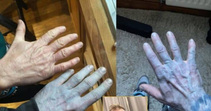 Ele acordou com a pele azul, mobilizou médicos e só no hospital percebeu o motivo constrangedor