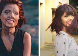 Ela tinha 2 meses quando o próprio pai jogou ácido nela; hoje, sua imagem está nas passarelas e na Vogue