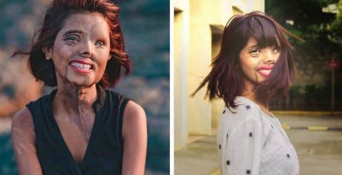 Ela tinha 2 meses quando o próprio pai jogou ácido nela; hoje, sua imagem está nas passarelas e na Vogue