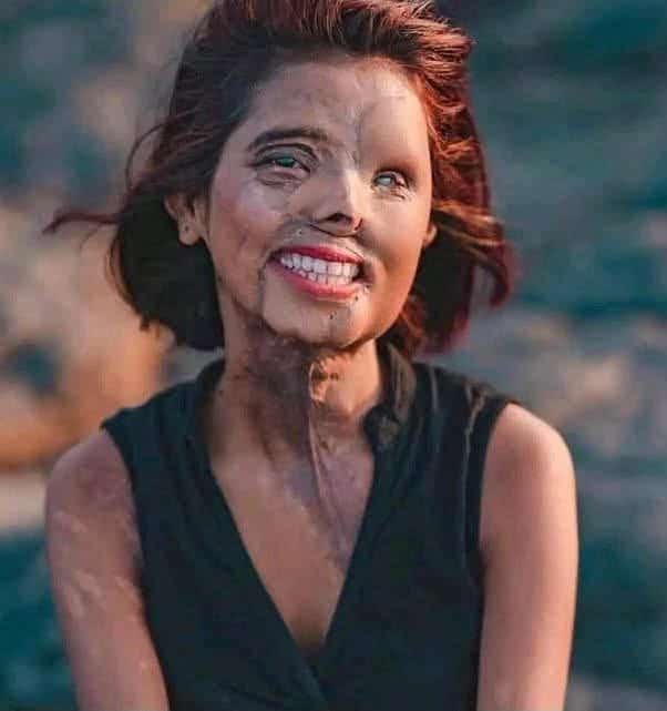 contioutra.com - Ela tinha 2 meses quando o pr&oacute;prio pai jogou &aacute;cido nela; hoje, sua imagem est&aacute; nas passarelas e na Vogue