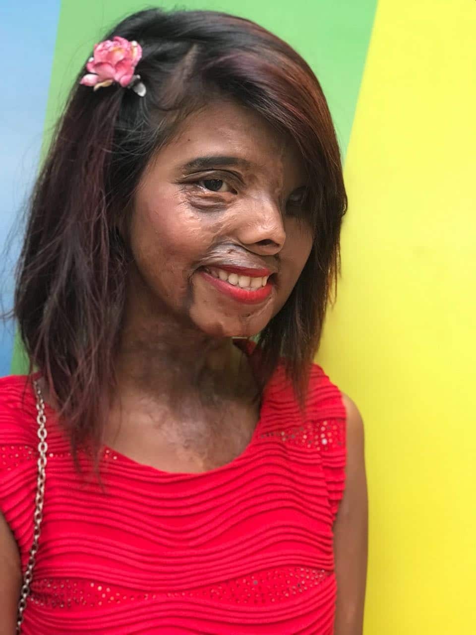 contioutra.com - Ela tinha 2 meses quando o pr&oacute;prio pai jogou &aacute;cido nela; hoje, sua imagem est&aacute; nas passarelas e na Vogue
