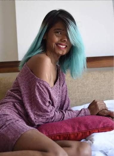 contioutra.com - Ela tinha 2 meses quando o pr&oacute;prio pai jogou &aacute;cido nela; hoje, sua imagem est&aacute; nas passarelas e na Vogue