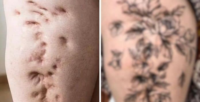 Ela carregava na perna a marca de um ataque de tubarão até tomar uma decisão surpreendente
