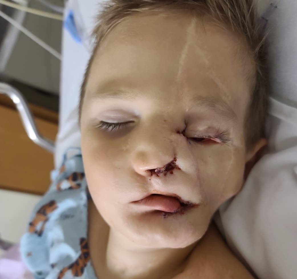 contioutra.com - Menino de 5 anos sobrevive a ataque brutal de dois c&atilde;es e &eacute; chamado de &ldquo;monstro&rdquo; em p&uacute;blico