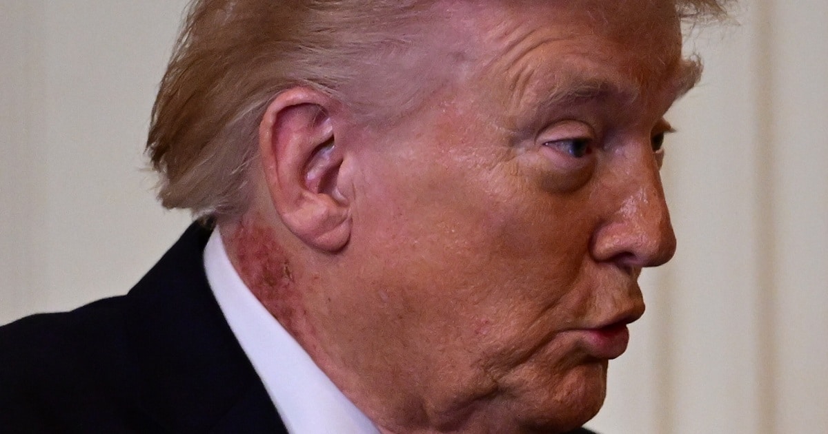 contioutra.com - Casa Branca d&aacute; uma explica&ccedil;&atilde;o surpreendente ap&oacute;s crostas no pesco&ccedil;o de Trump alimentarem especula&ccedil;&otilde;es sobre sua sa&uacute;de
